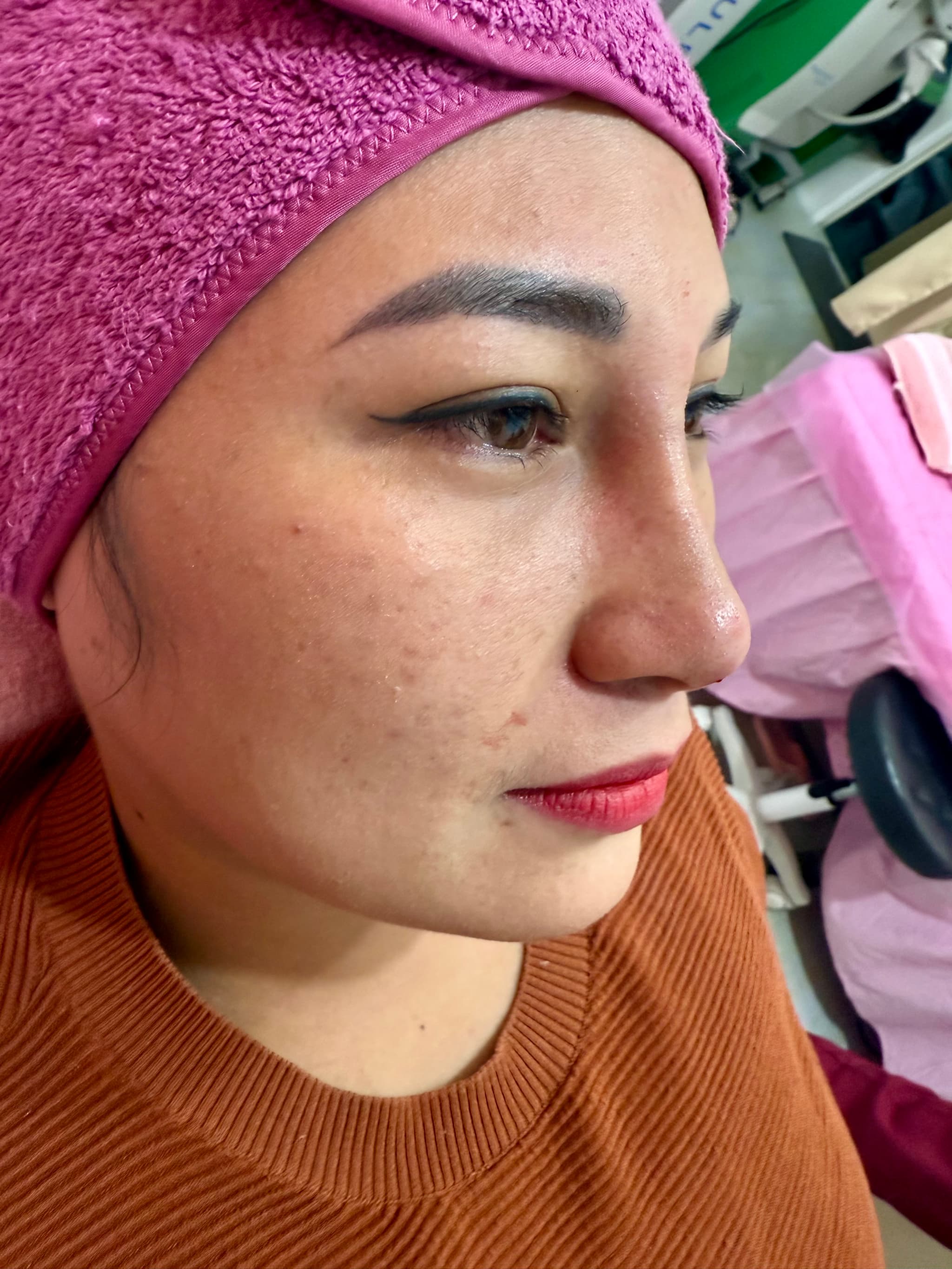 Hiko Nose Thread Lift Results in Quezon City