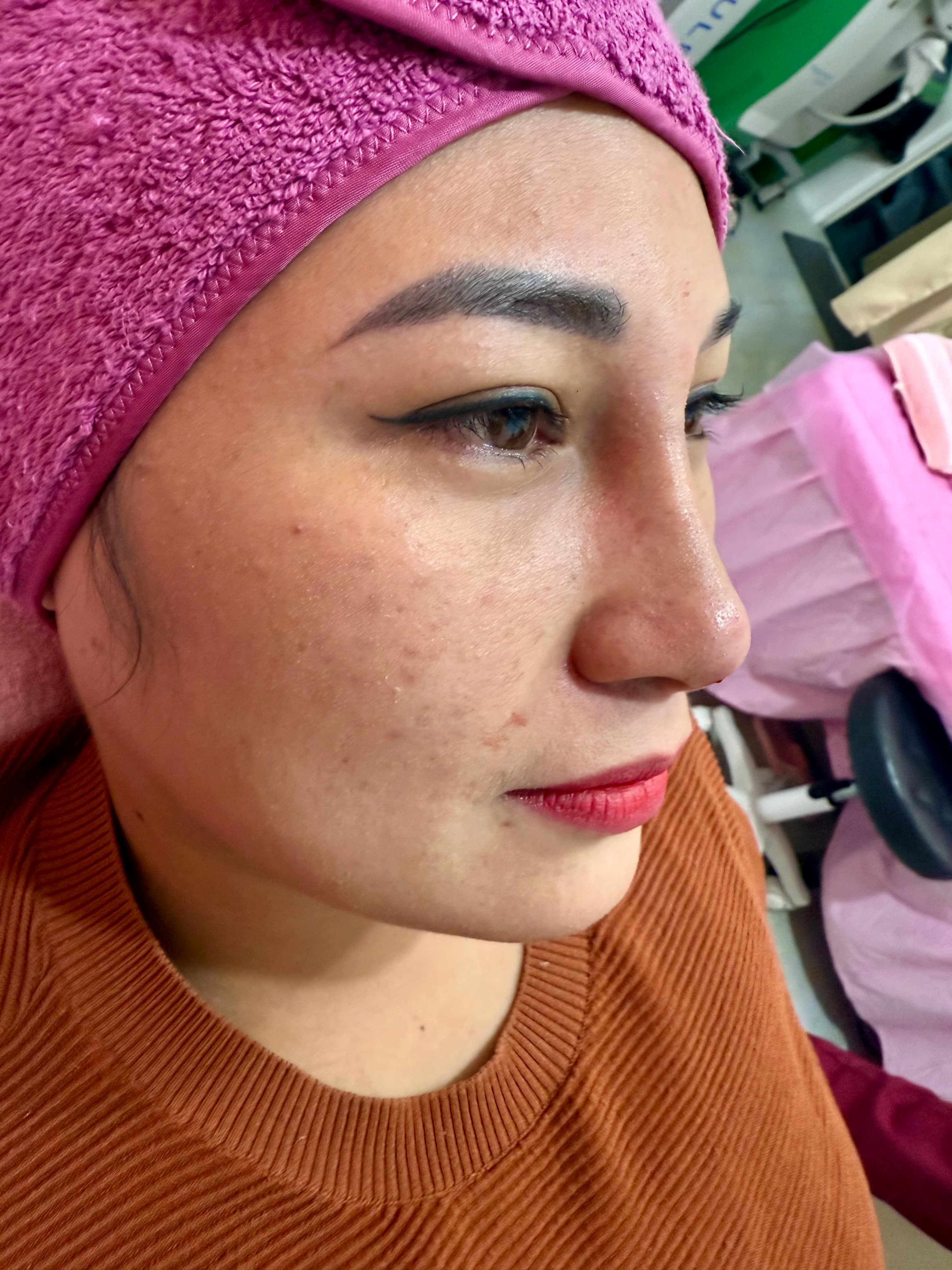 Hiko Nose Thread Lift Results in Quezon City