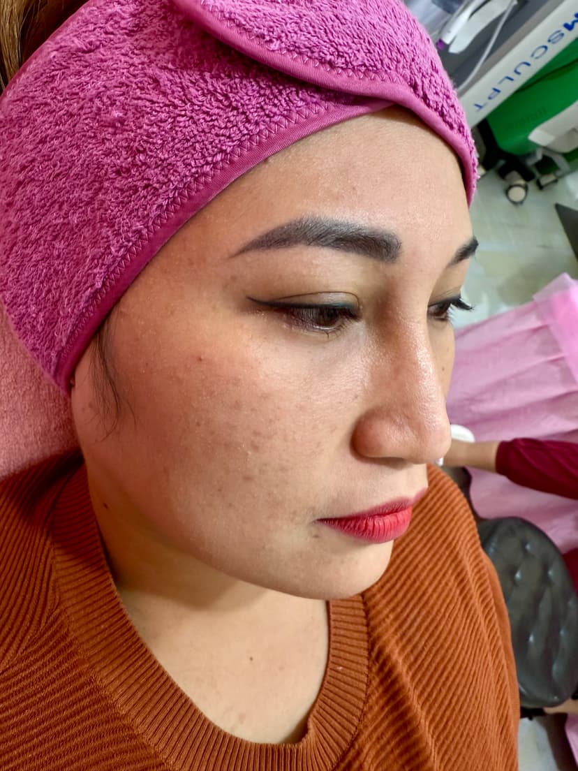 Before Hiko Nose Thread Lift